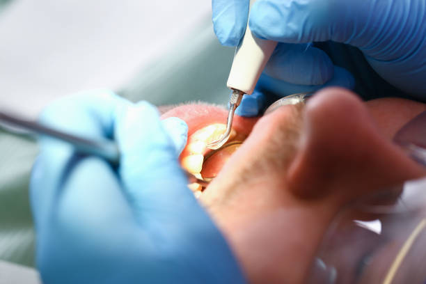 Best Chipped Tooth Repair Near Me  in Pleasure Point, CA